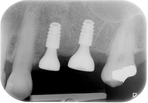 Onestage Implants — лучшее для стоматологии уже Украине